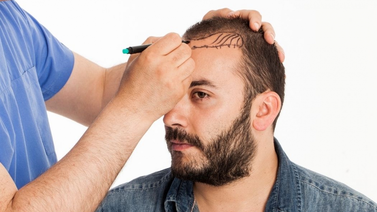 A Importância da Linha Frontal do Cabelo no Transplante Capilar em Ribeirão Preto